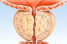 Urologist: Do This Immediately if You Have Enlarged Prostate (Watch)