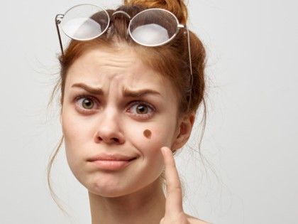 Κάντε το αμέσως εάν έχετε ετικέτες Moles ή Skin