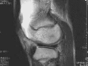 Bone on Bone Knees? Try This Move Once a Day