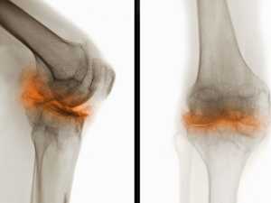 Bone on Bone? Try This, Says Top Doc