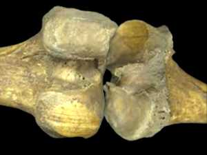 Bone on Bone? Do This Once a Day Says Doc