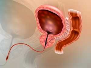 Anyone with Enlarged Protate Should Watch This (They Hide This from You)