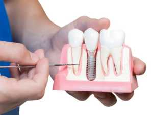 This is What Full Mouth Dental Implants Should Cost You in 2023